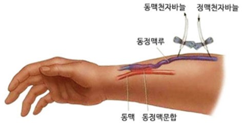 자가혈관 동정맥루 이미지
