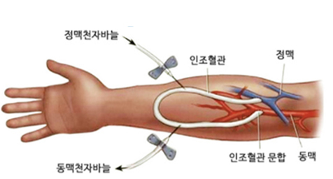 인조혈관 동정맥루 이미지