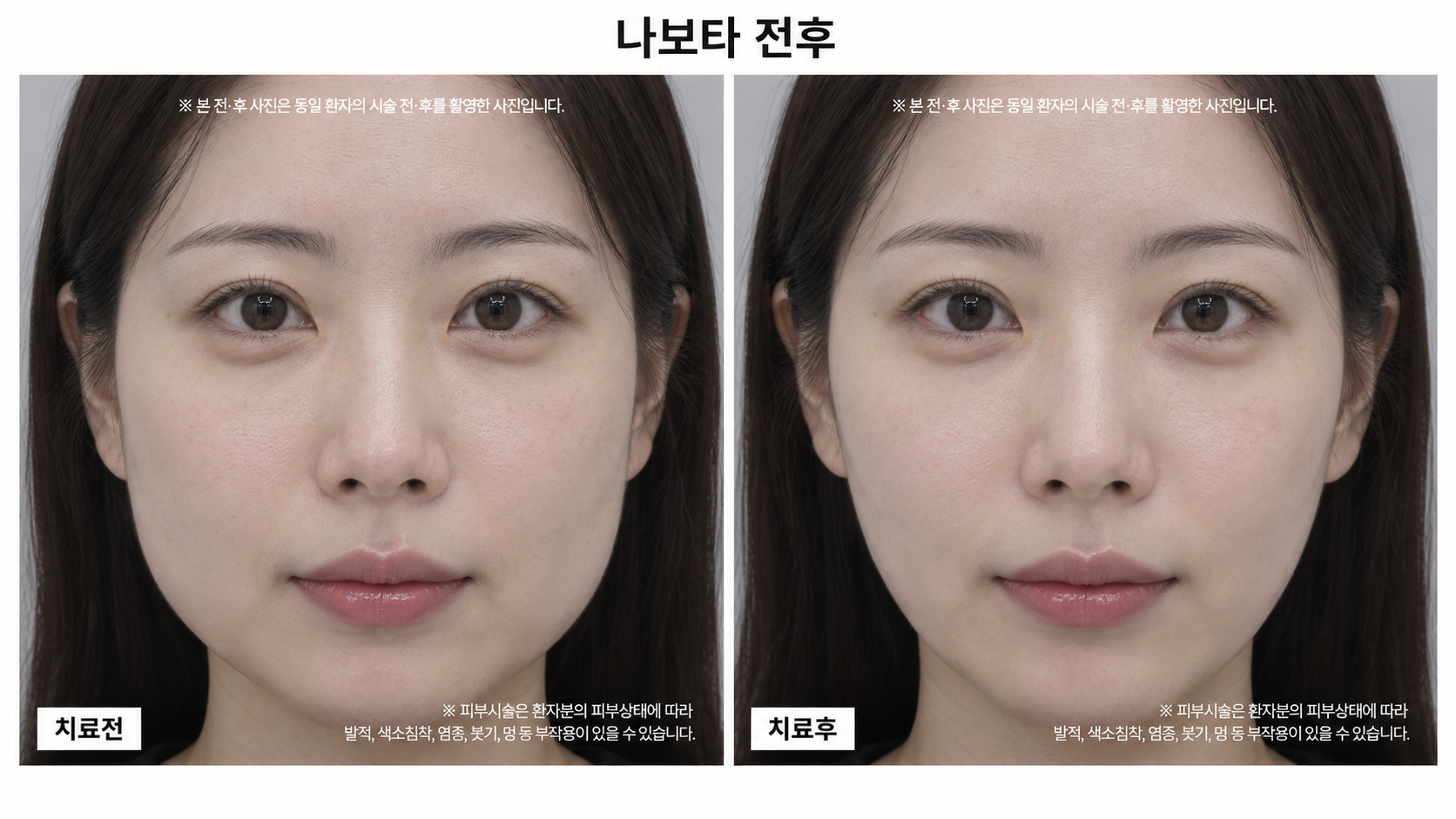 보톡스 시술 전후사진