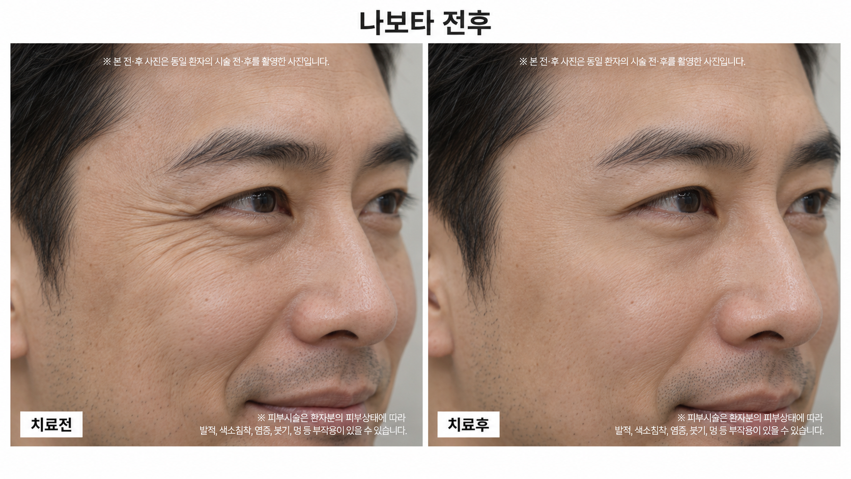 보톡스 시술 전후사진