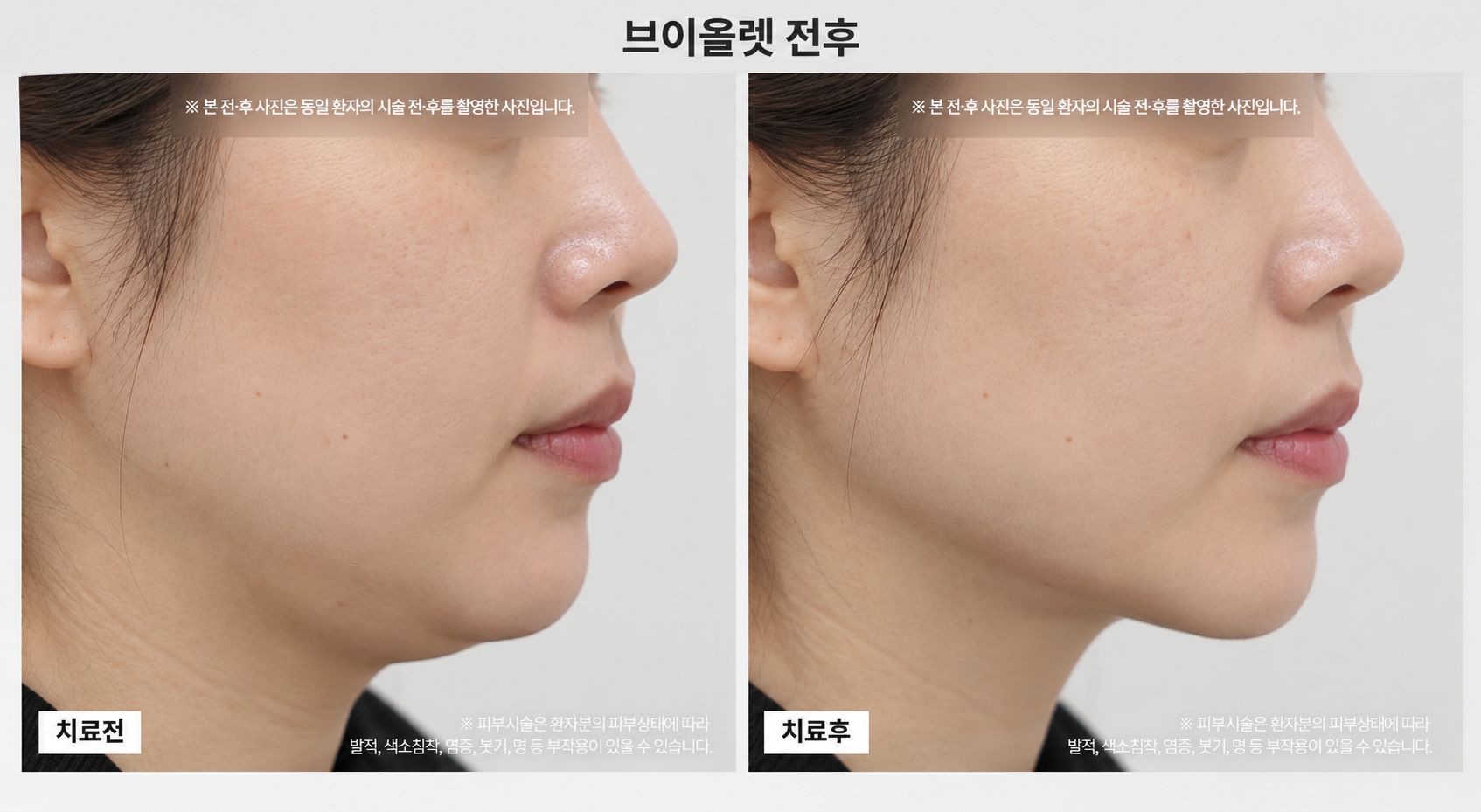 지방분해주사 전후사진