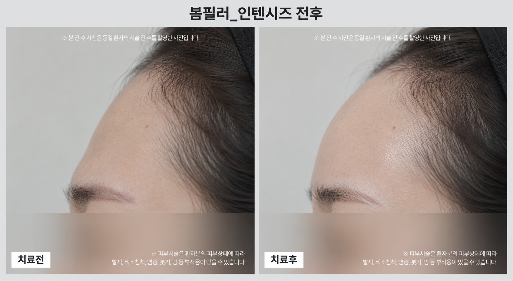 필러 시술 전후사진
