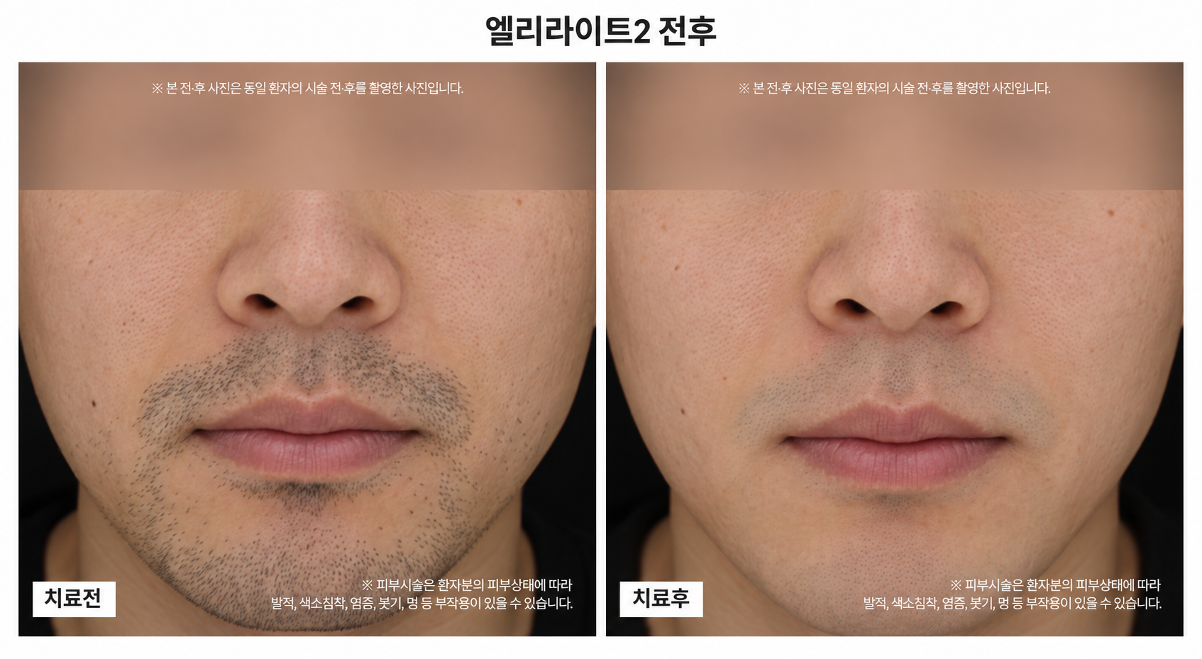 턱수염 제모 전후사진