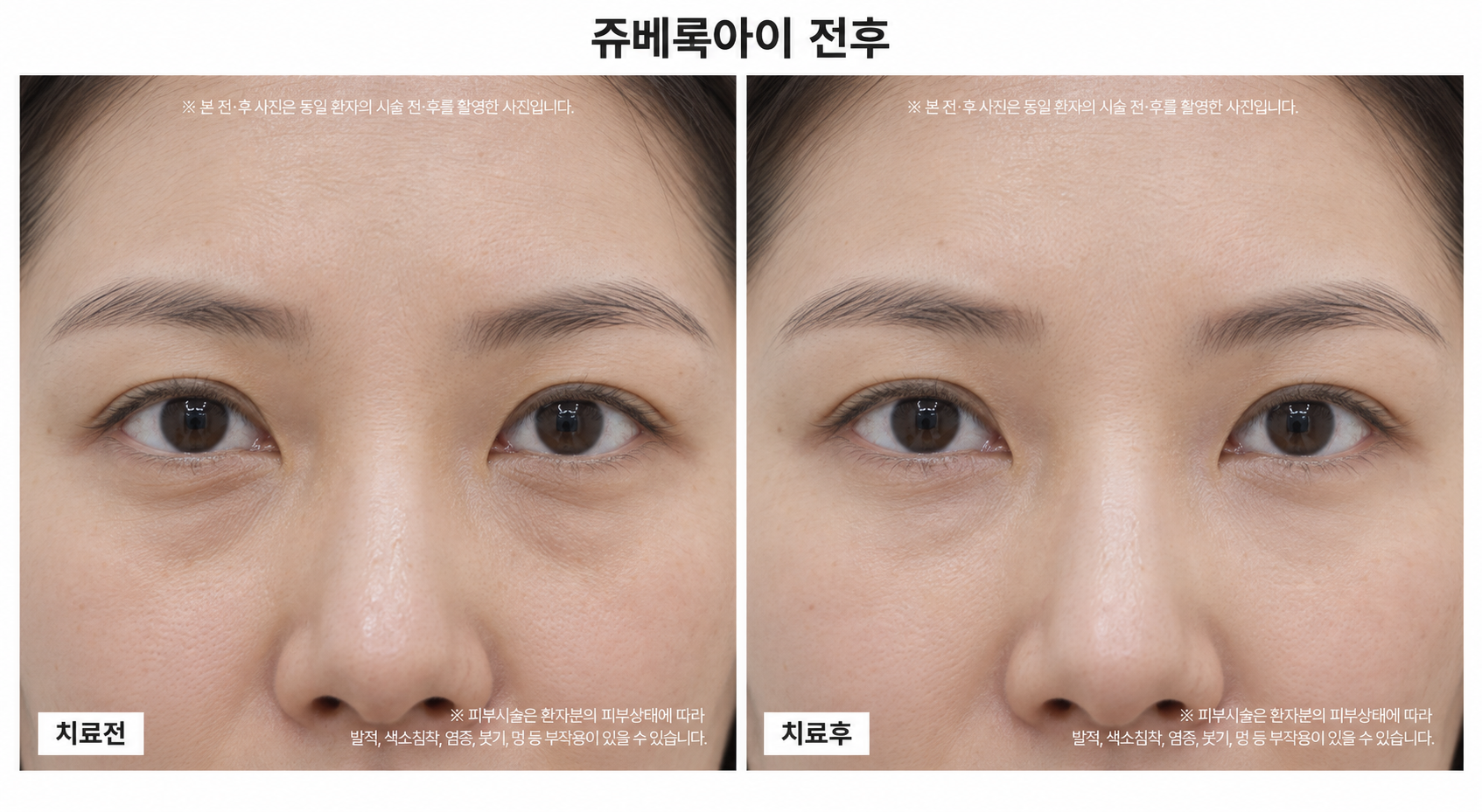 쥬베룩아이 전후사진