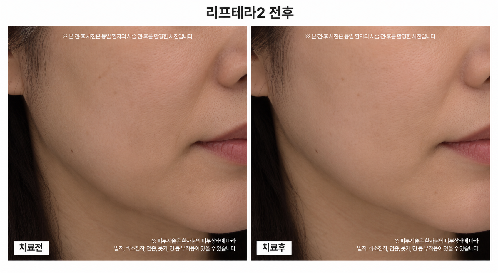 리프팅 시술 전후사진