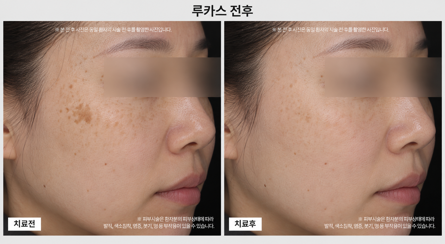 토닝레이저 전후사진
