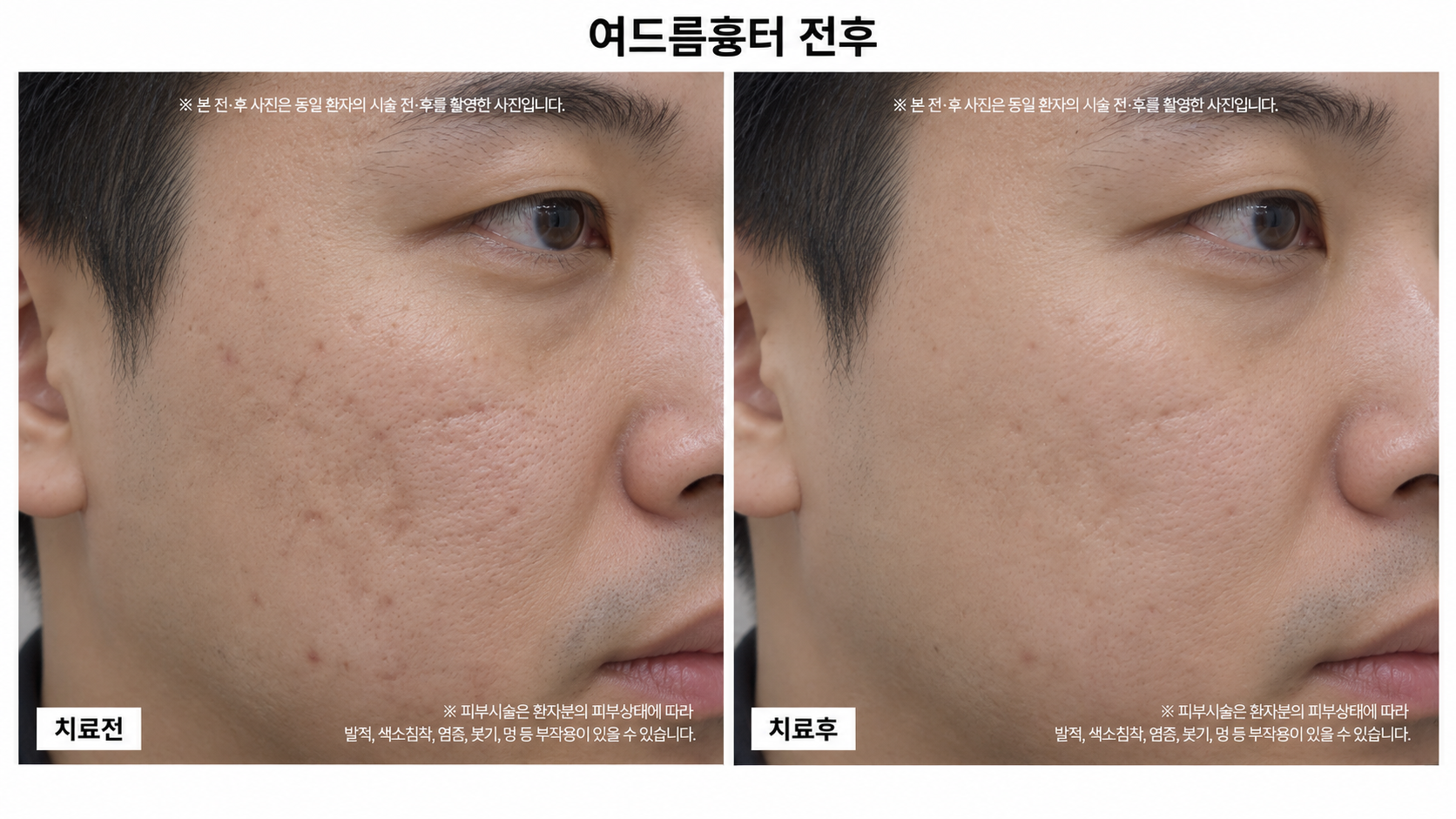 여드름흉터 전후사진
